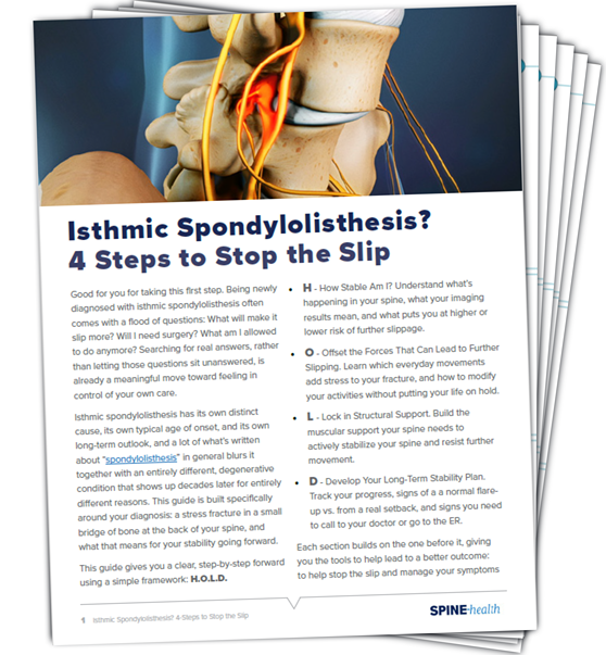 Isthmic Spondylolisthesis: 4-Steps to Stop the Slip